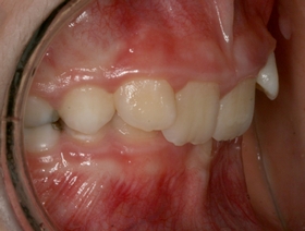 Transformez votre pratique de dentition mixte à l'aide des aligneurs