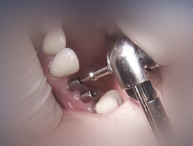 Restauration prothétique sur implants (Module 1 de 3)