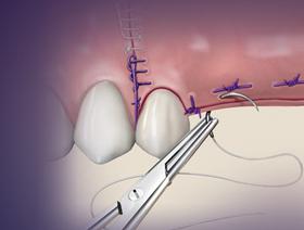 Techniques avancées de sutures (Module 2 de 5)
