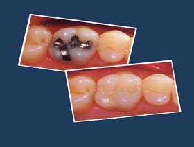 Insertion des composites par l'hygiéniste dentaire