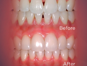 21st Century Composites : Stop Layering and Start Injection Molding!