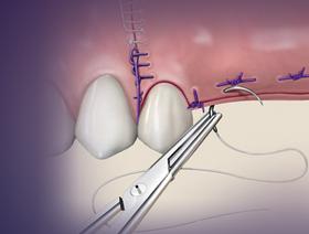 Techniques avancées de sutures (Module 2 de 5)