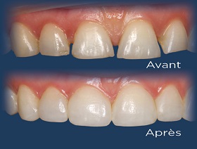 La restauration esthétique en composite des cas post-orthodontiques