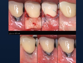 Novel approaches to soft tissue grafting at implant sites