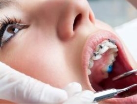 Orthodontie fixe et hybride avec planification digitalisée