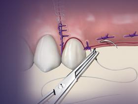 Techniques avancées de sutures
