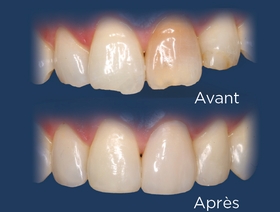 Techniques de facettes de composite artistique