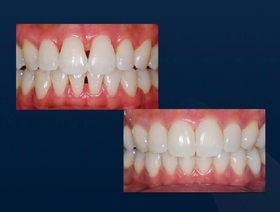 La méthode Bioclear® pour traiter les triangles noirs, diastèmes et restaurations classe II