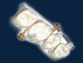 Mini-vis orthodontiques