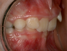 Traitement des phases 1 orthodontiques en aligneurs