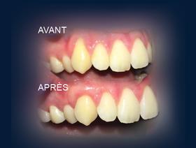 La chirurgie plastique parodontale en zone esthétique