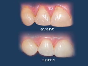 Techniques avancées de greffes gingivales