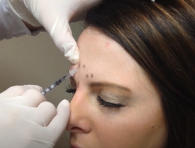 Toxine botulique type A (BoNT/A) : Esthétique haut du visage et gestion thérapeutique du bruxisme