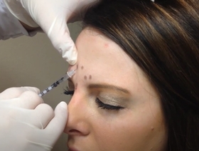 Toxines botuliques type A : Esthétique haut du visage & gestion thérapeutique du bruxisme