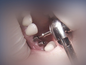 Restauration prothétique sur implants