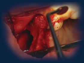 Techniques avancées en implantologie chirurgicale