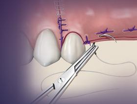 Techniques avancées de sutures