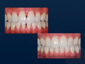 La méthode Bioclear® pour traiter les triangles noirs, diastèmes et restaurations classe II