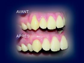 La chirurgie plastique parodontale en zone esthétique (Module 5 de 5)