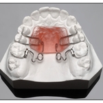 Upper Arch Molar Distalization Appliances in Treatment of Class II Malocclusion: A Critical Analysis